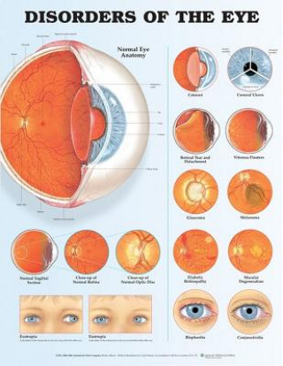 Carte Disorders of the Eye Anatomical Chart 