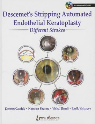 Livre Descemet's Stripping Automated Endothelial Keratoplasty: Different Strokes Dermot Cassidy