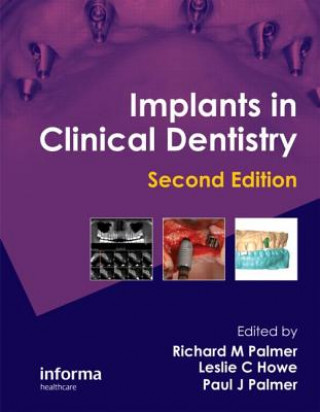 Kniha Implants in Clinical Dentistry R M Palmer