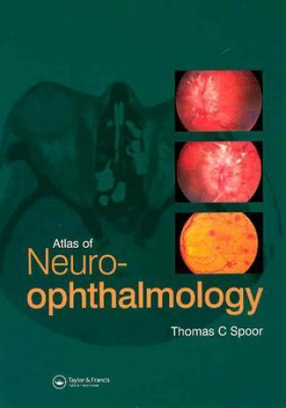 Kniha Atlas of Neuro-ophthalmology Thomas C Spoor