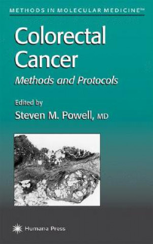 Carte Colorectal Cancer Steven M. Powell