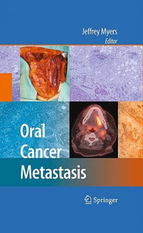 Carte Oral Cancer Metastasis Jeffrey Myers