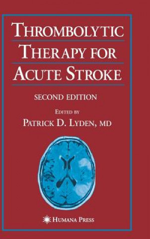 Carte Thrombolytic Therapy for Acute Stroke yden