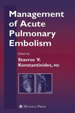 Kniha Management of Acute Pulmonary Embolism Stavros V. Konstantinides