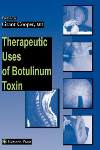 Kniha Therapeutic Uses of Botulinum Toxin Grant Cooper