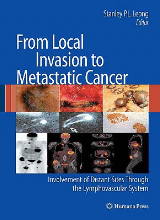 Könyv From Local Invasion to Metastatic Cancer Stanley P. L. Leong