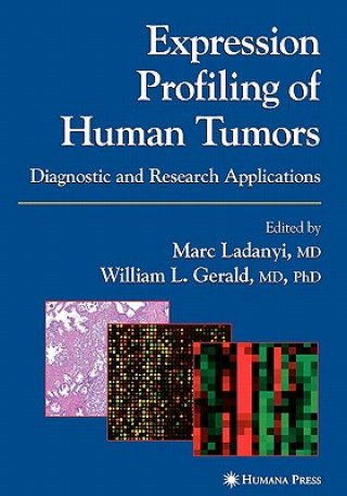 Carte Expression Profiling of Human Tumors Marc Ladanyi