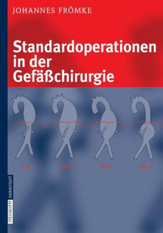 Buch Standardoperationen in der Gefasschirurgie Johannes Frömke