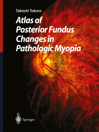 Carte Atlas of Posterior Fundus Changes in Pathologic Myopia Takashi Tokoro
