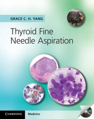 Carte Thyroid Fine Needle Aspiration with CD Extra Grace C H Yang