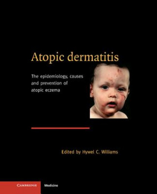 Книга Atopic Dermatitis Hywel C. Williams