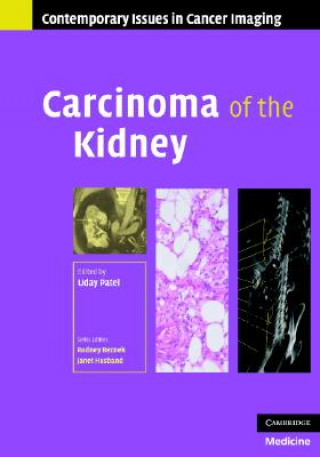 Książka Carcinoma of the Kidney Uday Patel