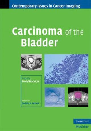 Carte Carcinoma of the Bladder David MacVicar