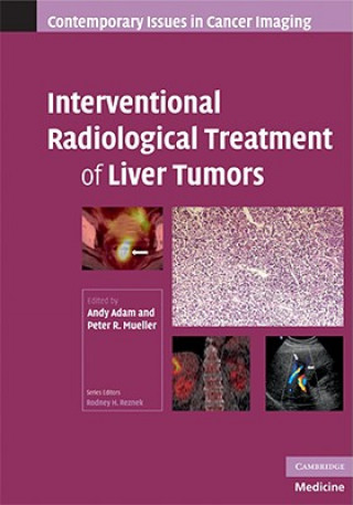 Книга Interventional Radiological Treatment of Liver Tumors Andy  AdamPeter R.  Mueller