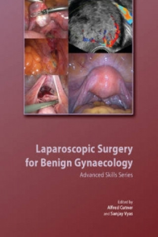 Carte Laparoscopic Surgery for Benign Gynaecology Hardback with DVDs Alfred CutnerSanjay Vyas