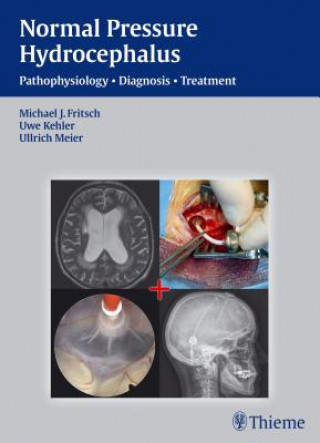 Книга NPH - Normal Pressure Hydrocephalus Michael J. Fritsch