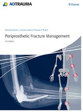 Книга Periprosthetic Fracture Management Michael Schütz