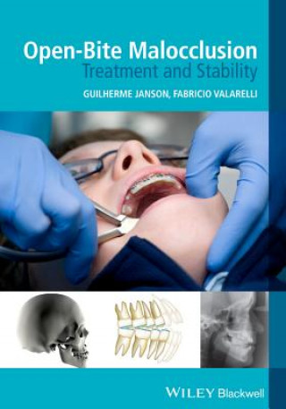 Book Open-Bite Malocclusion - Treatment and Stability Guilherme Janson