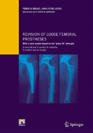 Carte Revision of loose femoral prostheses with a stem system based on the "press-fit" principle Pierre Le Beguec