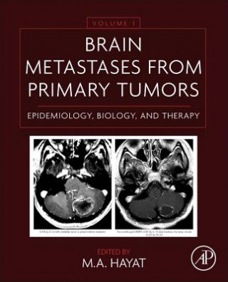 Carte Brain Metastases from Primary Tumors Volume 1 M A Hayat