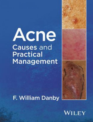 Könyv Acne - Causes and Practical Management F William Danby