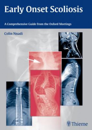 Carte Early Onset Scoliosis Colin Nnadi