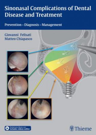 Kniha Sinonasal Complications of Dental Disease and Treatment Giovanni Felisati
