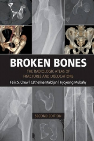 Carte Broken Bones Felix S. Chew