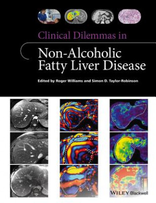 Carte Clinical Dilemmas in Non-Alcoholic Fatty Liver Disease Roger Williams