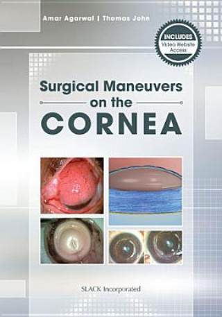 Carte Mastering Corneal Surgery Thomas John