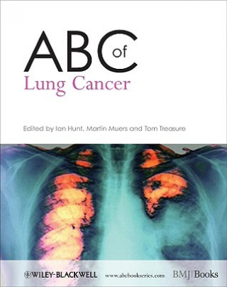 Kniha ABC of Lung Cancer Ian Hunt