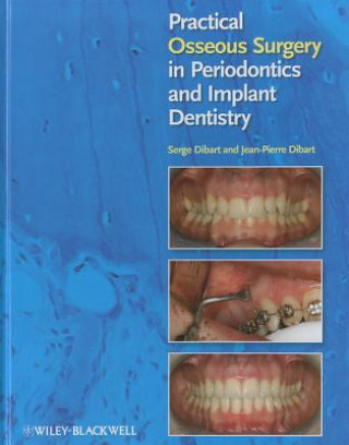 Książka Practical Osseous Surgery in Periodontics and Implant Dentistry Serge Dibart