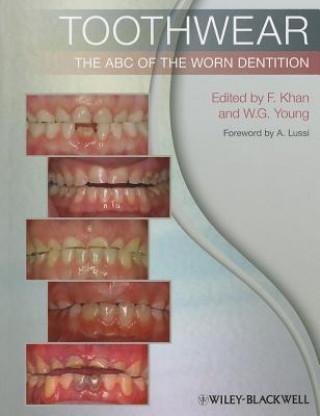 Książka Toothwear - The ABC of the Worn Dentition Farid Khan