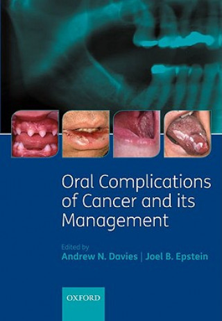 Kniha Oral Complications of Cancer and its Management Andrew Davies