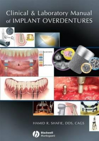Книга Clinical and Laboratory Manual of Implant Overdentures Hamid Shafie