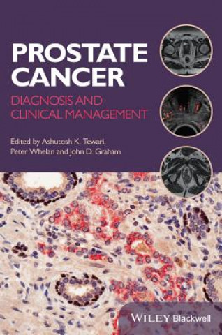 Книга Prostate Cancer - Diagnosis and Clinical Management Peter Whelan