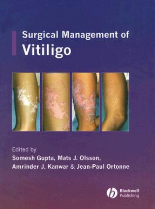 Carte Surgical Management of Vitiligo Somesh Gupta