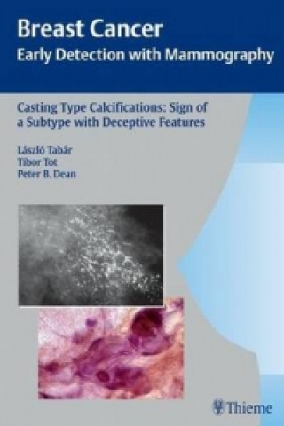 Könyv Casting-Type Calcifications: Sign of a Subtype with Deceptive Features Peter B. Dean