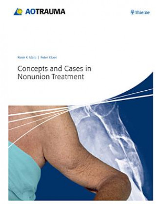 Kniha Concepts and Cases in Nonunion Treatment Peter Kloen