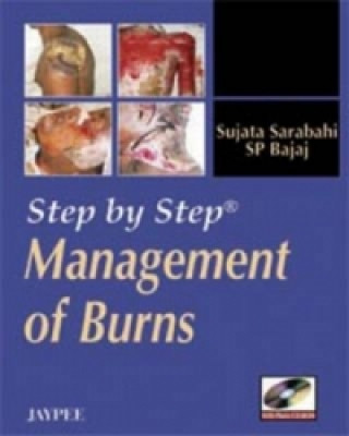 Carte Step by Step: Management of Burns Sujata Sarabahi