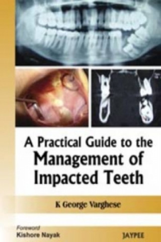 Carte Practical Guide to the Management of Impacted Teeth George K. Varghese