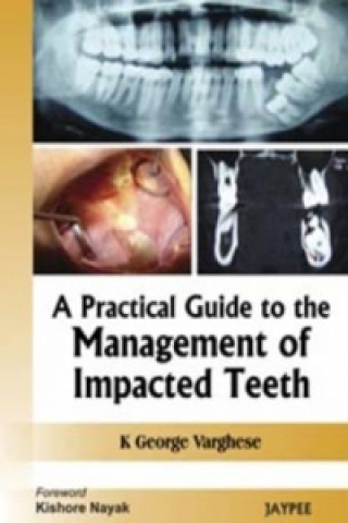 Książka Practical Guide to the Management of Impacted Teeth George K. Varghese