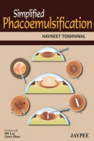 Carte Simplified Phacoemulsification Navneet Toshniwal