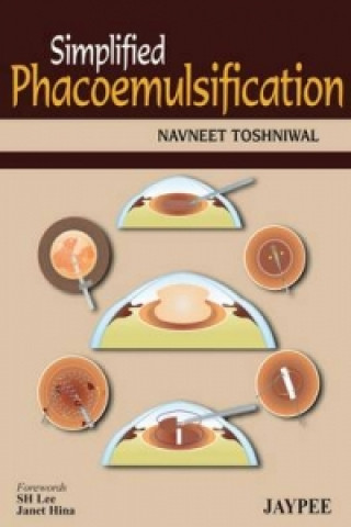 Kniha Simplified Phacoemulsification Navneet Toshniwal