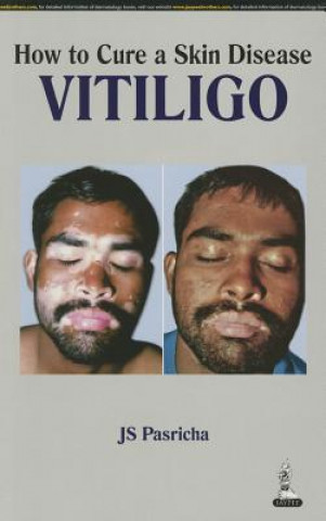 Carte How to Cure a Skin Disease: Vitiligo J. S. Pasricha