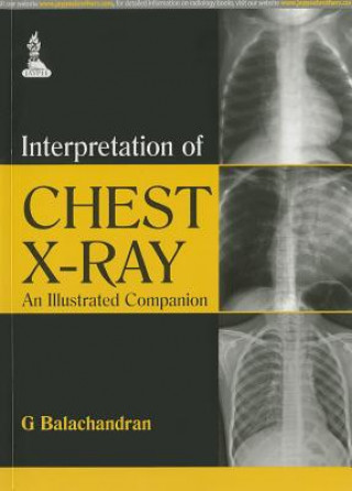 Kniha Interpretation of Chest X-Ray G. Balachandran