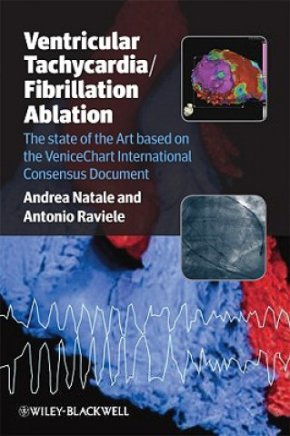 Carte Ventricular Tachycardia / Fibrillation Ablation - The State of the Art based on the Venicechart International Consensus Document Antonio Raviele