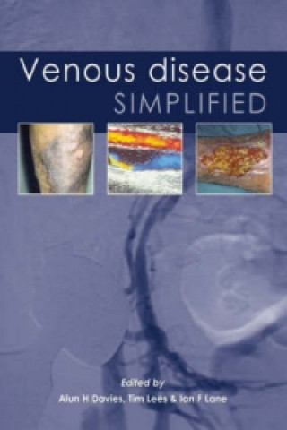 Könyv Venous Disease Simplified H. Davies
