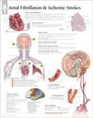 Prasa Atrial Fib & Ischemic Strokes Paper Poster Scientific Publishing