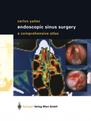 Carte Endoscopic Sinus Surgery Carlos Yanez